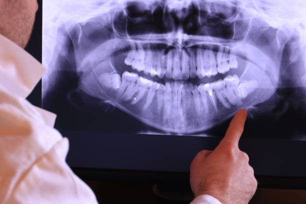 Best Emergency Wisdom Tooth Extraction in Groesbeck, OH